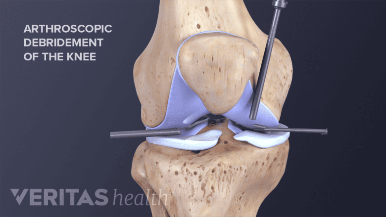 Illustration showing surgical debridement of the damaged knee cartilage.