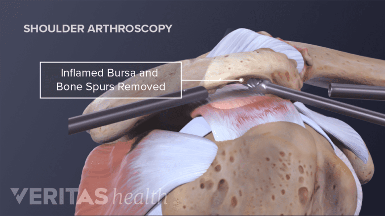 Shoulder joint anatomy  showing arthroscopic shoulder repair surgery.