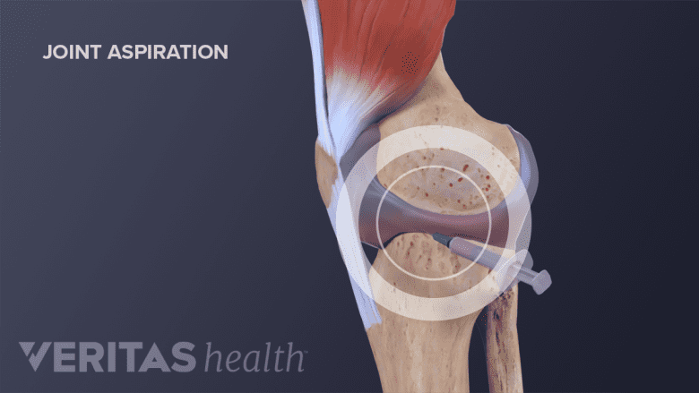 Joint aspiration in the knee.