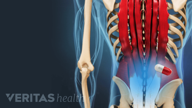 Dolor lumbar con una pastilla AINE.