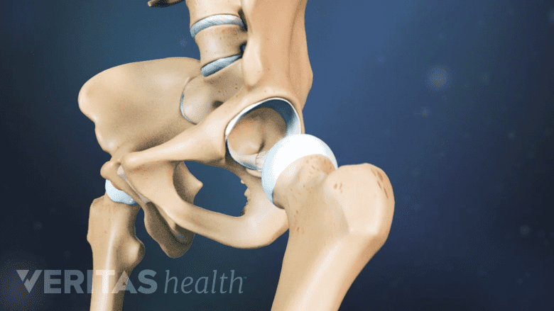 Dislocated hip joint to show the individual components.