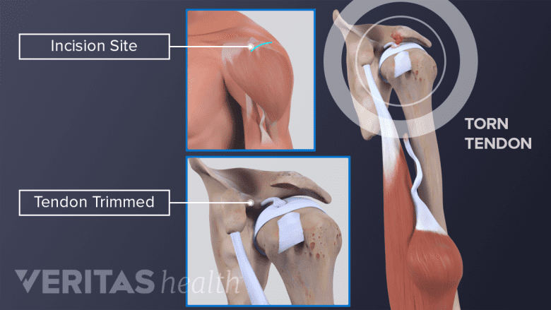 Illustration showing torn tendon, incision site, and tendon trimmed.