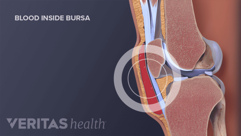 Prepatellar bursa filled with blood.