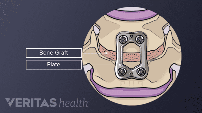 Labeled illustration of a cervical bone graft fusion.