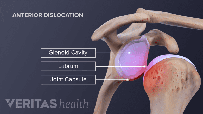 Anterior view of the shoulder joint showing a dislocated humerus showing the joint capsule, glenoid, and labrum
