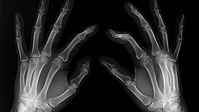 X-ray hand with a broken finger.