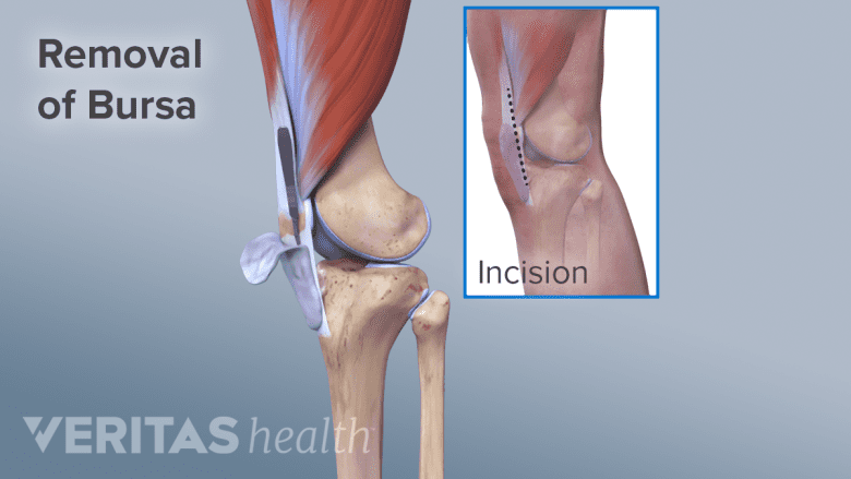 Bursectomy procedure of the prepatellar bursa.