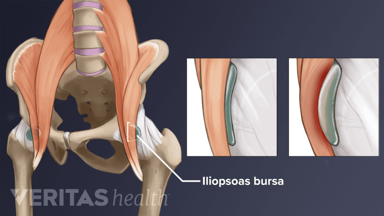 Anterior view of iliopsoas bursitis in the hip