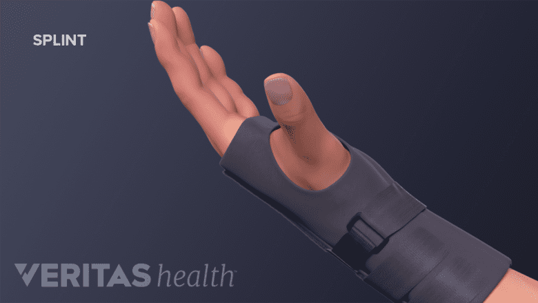 Wrist in a brace