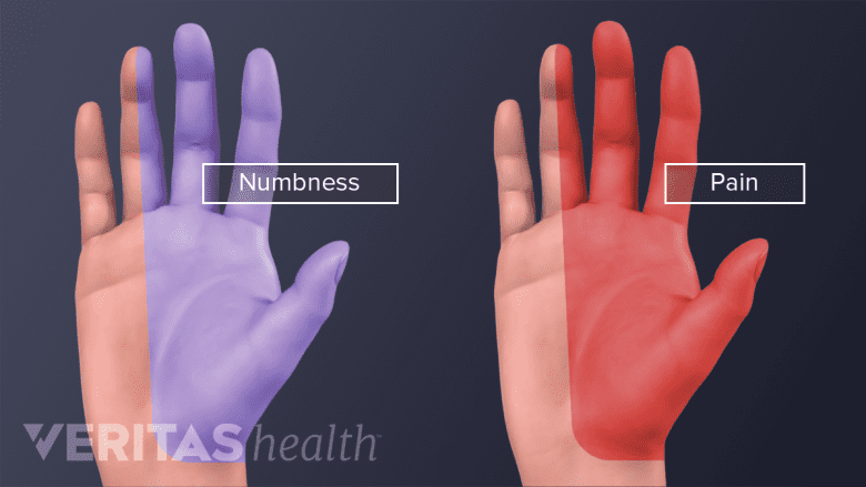 Palmar view of the hands showing numbness and pain.