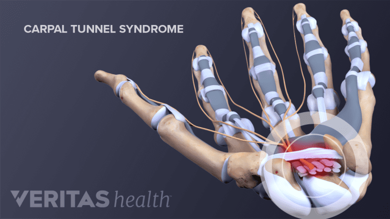 Anatomy of hand showing carpal tunnel syndrome.