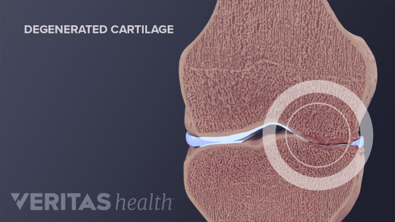 Degenerated cartilage in the knee joint