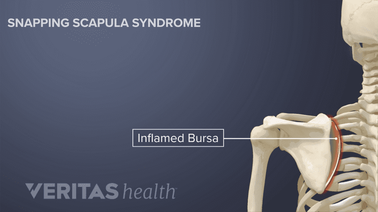 Bursitis occurring in the shoulder.