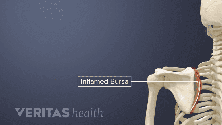 Inflamed bursitis of the shoulder.