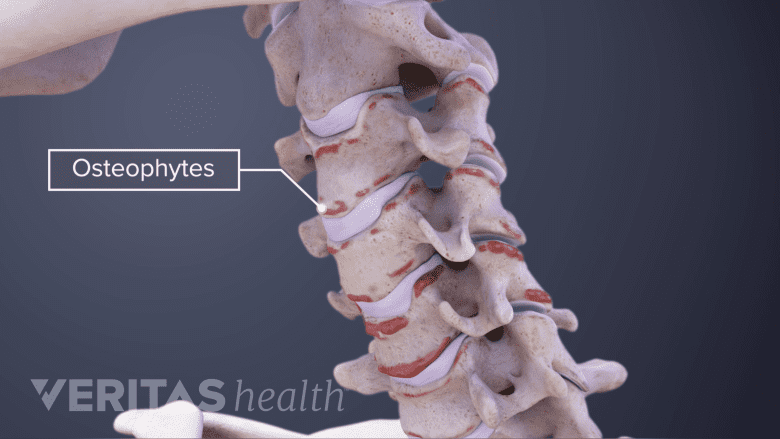 Illustration showing cervical spine with osteophytes.