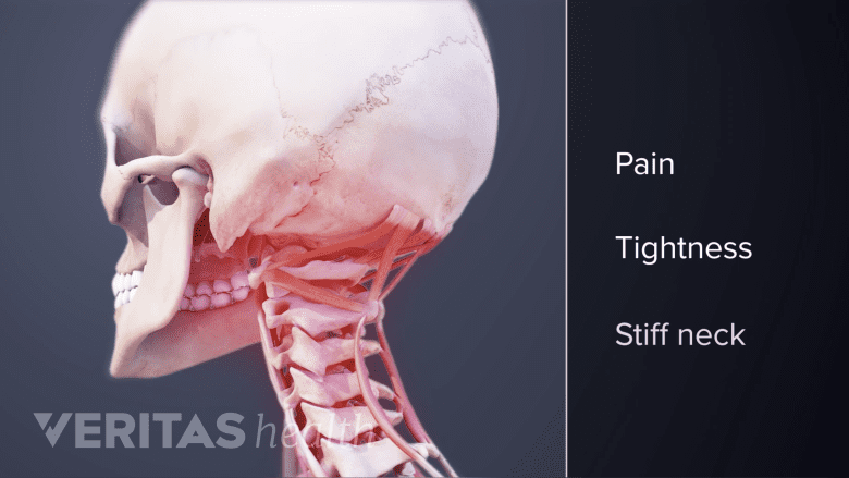 Symptoms or poor neck posture.