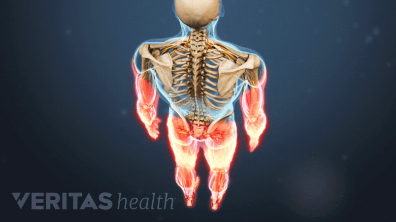Illustration showing a skeleton with arms and legs highlighted in red.