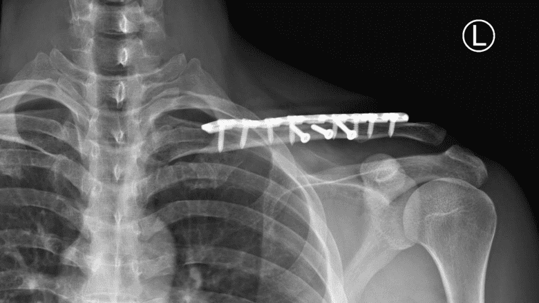 Clavicle surgery with plate and screws.