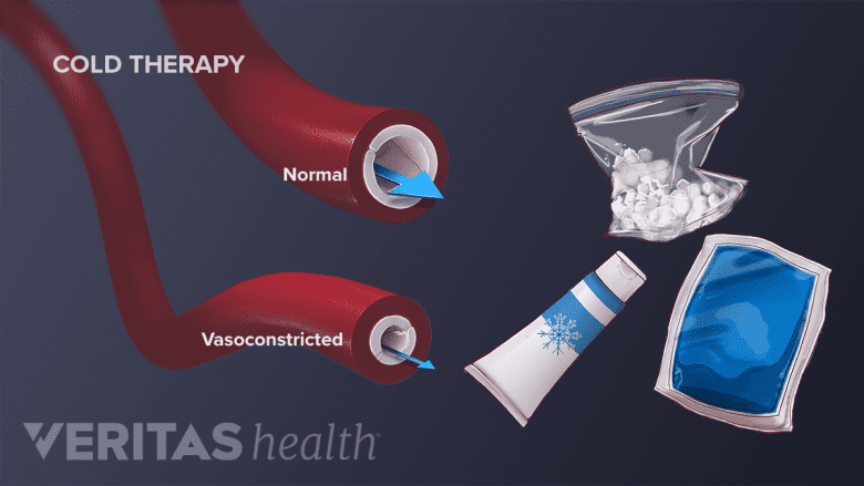 Illustration of the types of cold therapy and vasoconstricted blood vessels