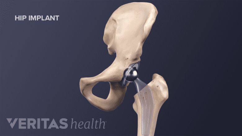 Medical illustration of a placed hip implant