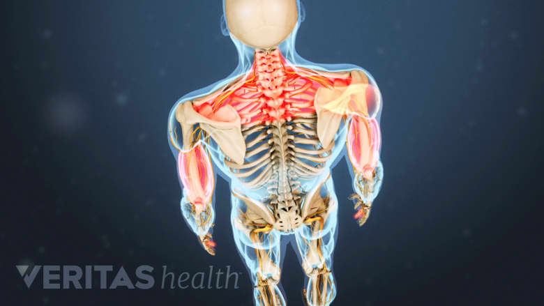 An illustration showing shoulders and both arms highlighted in red.