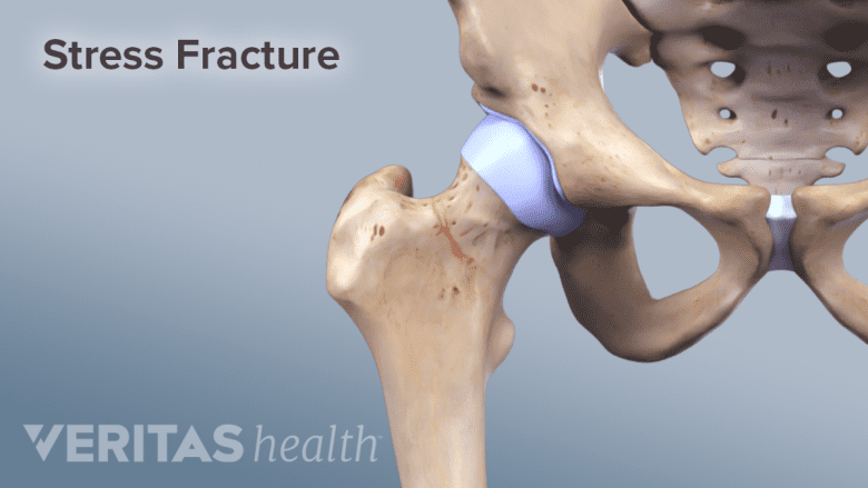 Illustration of Hip joint anatomy showing femoral fracture.