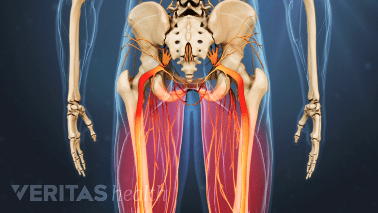 Posterior diagram of the nerves of the legs with pain highlight in red.