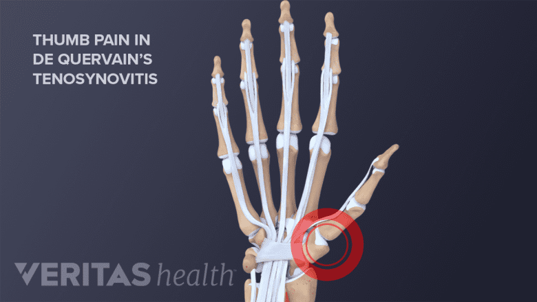 Anatomy of hand d wrist showing pain in the base of the thumb.