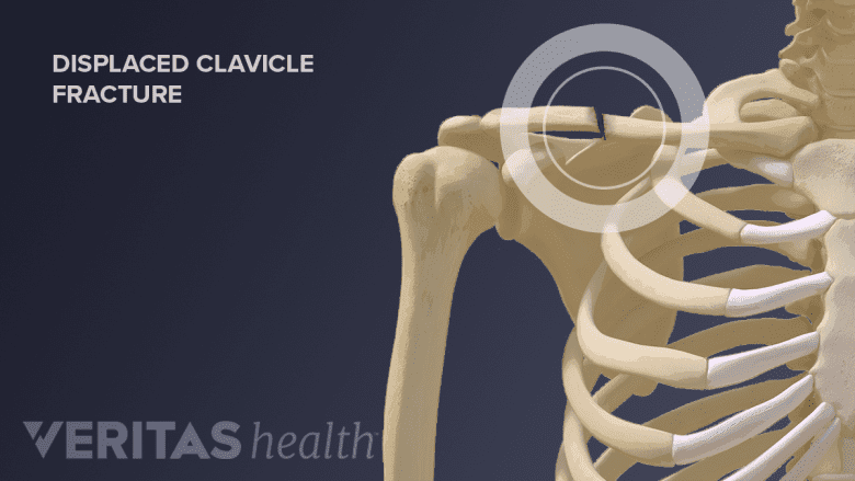 Displaced clavicle fracture.
