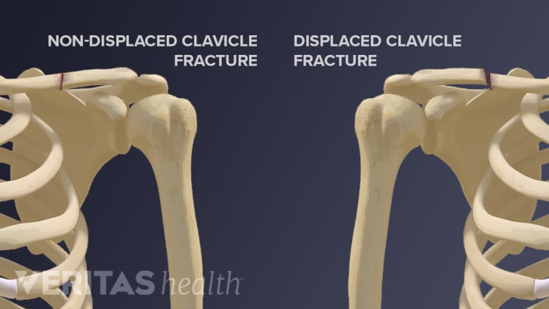 types of clavicle fracture