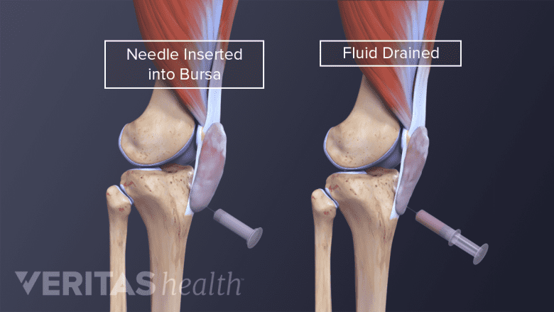 BursitisIllustration of knee bursa being drained