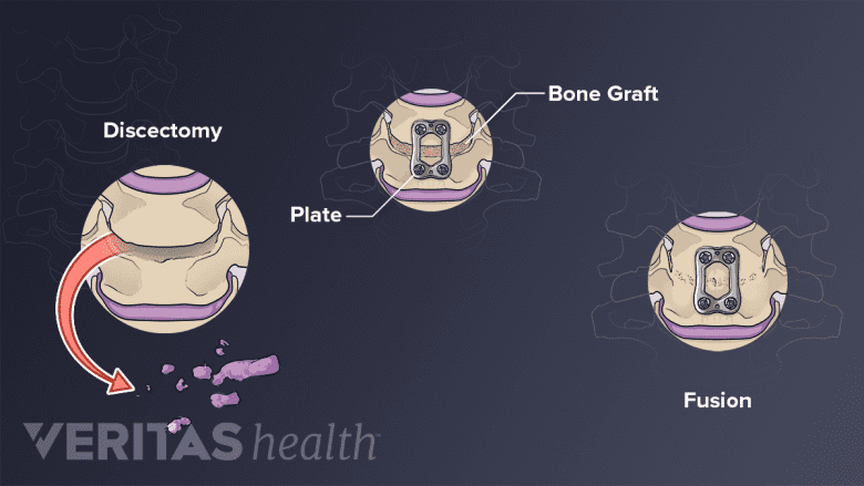 3-part diagram showing the process of discectomy and fusion.