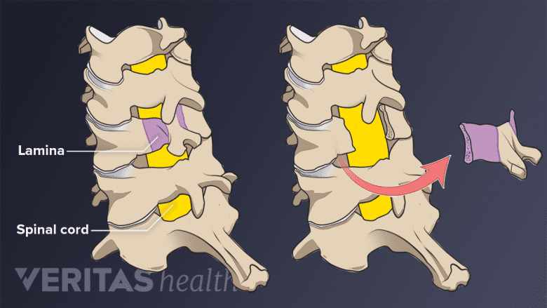 A medical illustration showing posterior laminectomy.