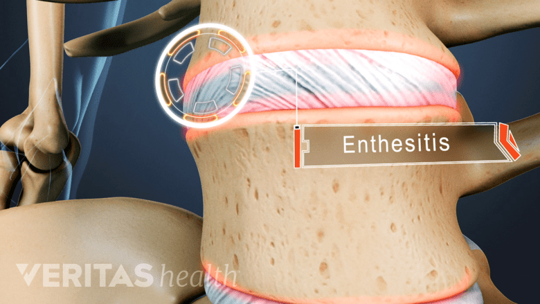 Illustration showing lumbar spine with enthesitis.