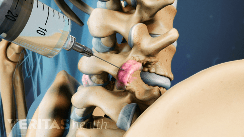 Illustration showing facet joint highlighted in pink with a needle inserted into the joint.