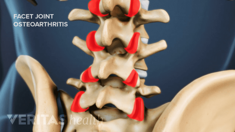 Illustration showing lumbar facet joint arthritis.