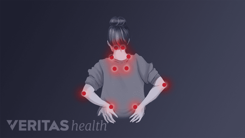 Pressure points in the back from fibromyalgia.
