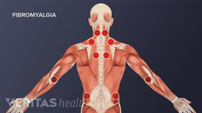 Illustration showing posterior view of torso with red trigger points.