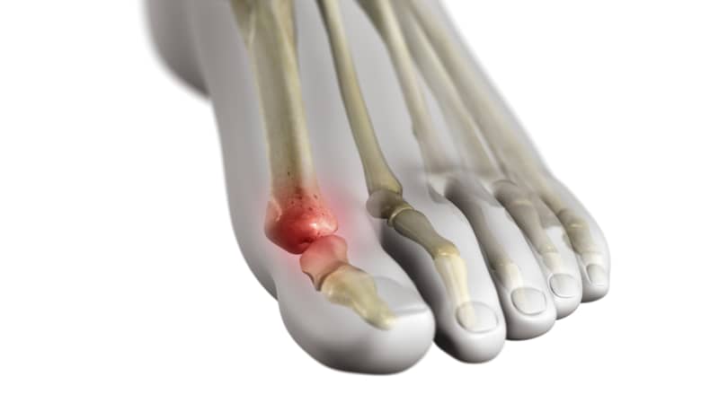 Gout in the big toe