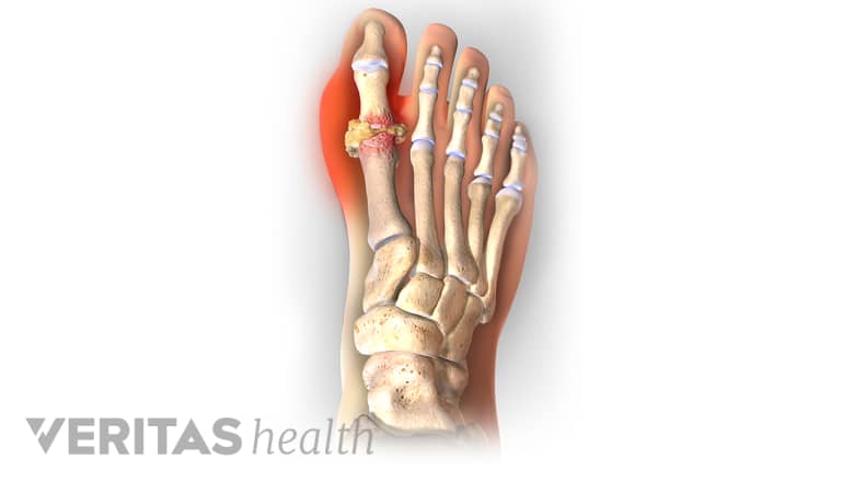 Illustration showing pain caused by gout in the big toe