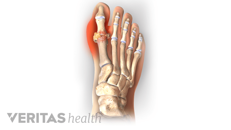 Gout occurring in the big toe.