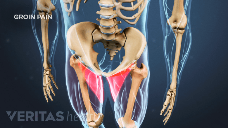 Illustration showing anatomy of hip with groin area highlighted in red.