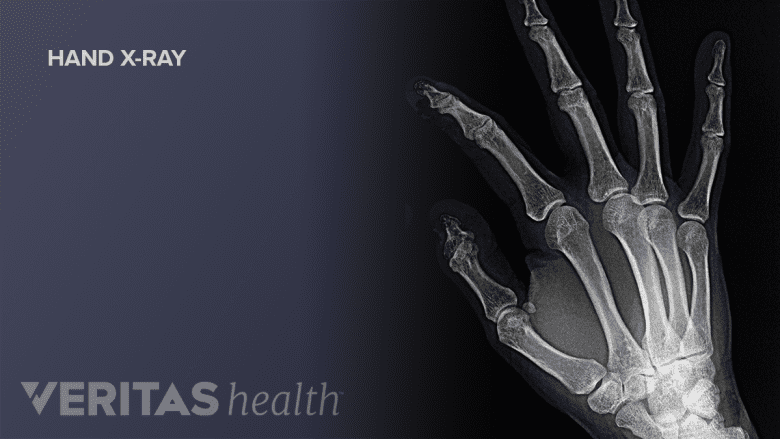 Illustration showing hand wrist x-ray.