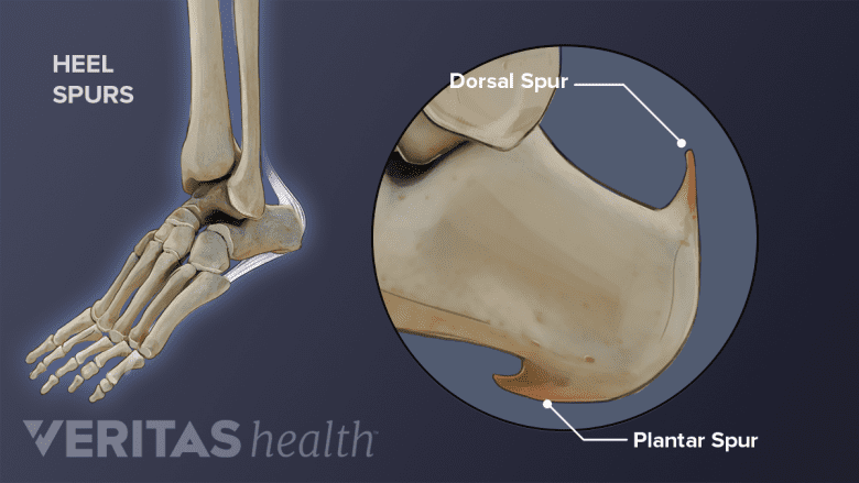 Illustration showing anatomy of heel with an inset showing dorsal and plantar spur.