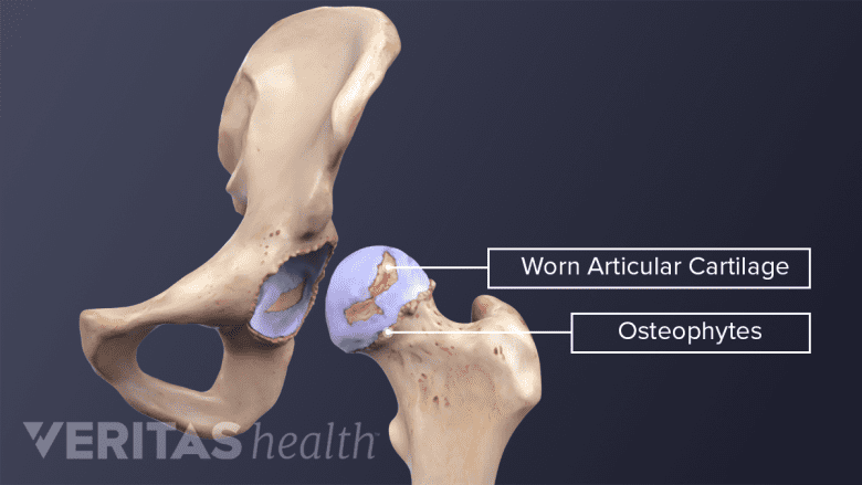 Illustration showing worn cartilage and osteophytes in the hip