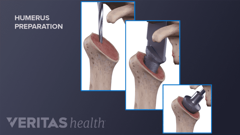 Preparation of the humeral component of a reverse total shoulder surgery.