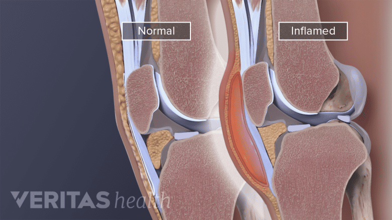 Inflamed and regular prepatellar bursae.