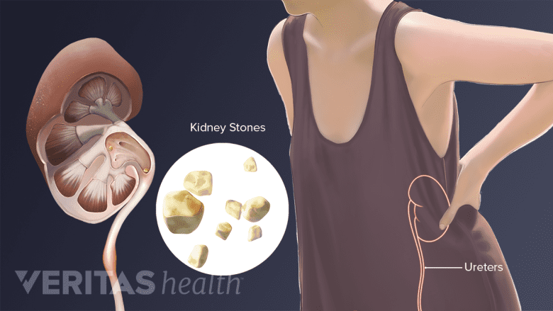 An illustration showing kidney stones.