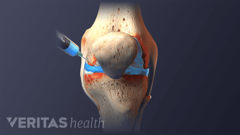 knee joint pain treatment inject vitamin b12 Injections: Your Path to Pain-Free Mobility Injections - Chiropractic Essence