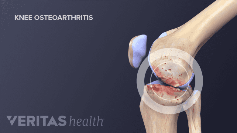 Anatomy of knee joint showing knee osteoarthritis.
